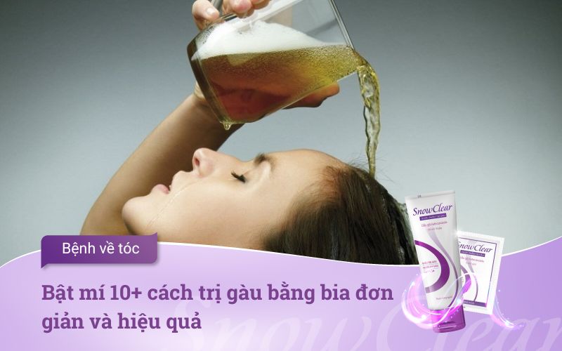 Bật mí 10+ cách trị gàu bằng bia đơn giản và hiệu quả