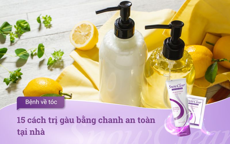 15 cách trị gàu bằng chanh an toàn tại nhà