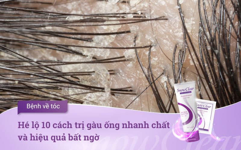 Hé lộ 10 cách trị gàu ống nhanh nhất và hiệu quả bất ngờ