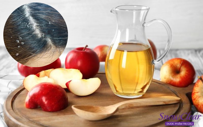  Cách trị gàu dứt điểm với giấm táo