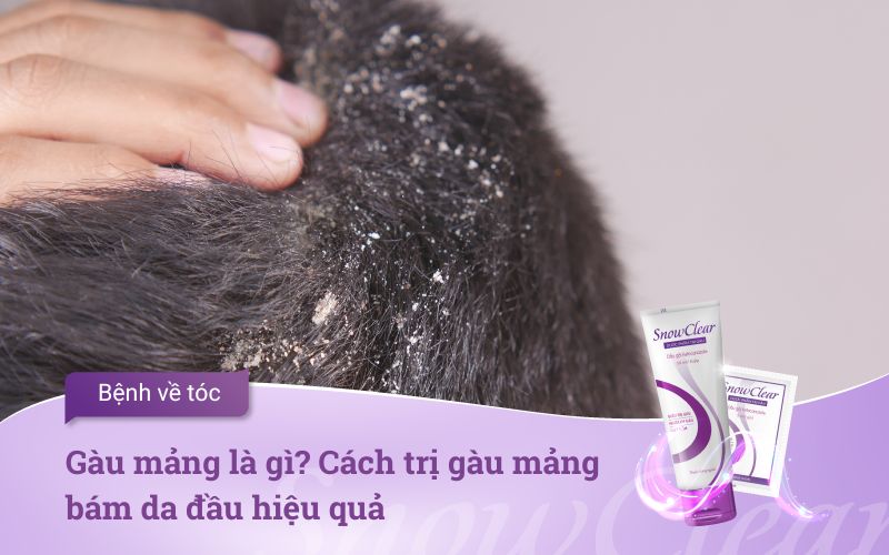 Gàu mảng là gì? Cách trị gàu mảng bám da đầu hiệu quả