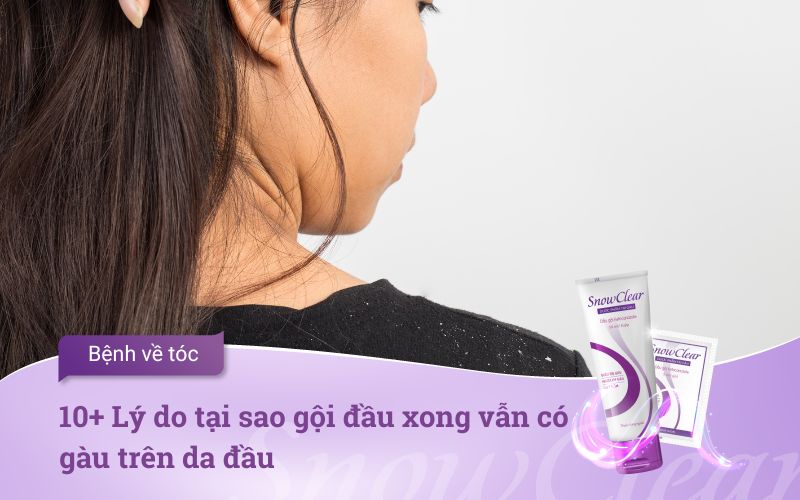 10+ Lý do tại sao gội đầu xong vẫn có gàu trên da đầu