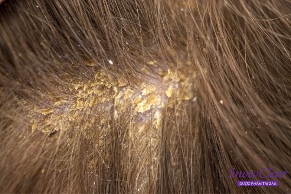 Da đầu bị bệnh lý tăng tiết bã nhờn khiến đầu dễ sinh gàu hơn