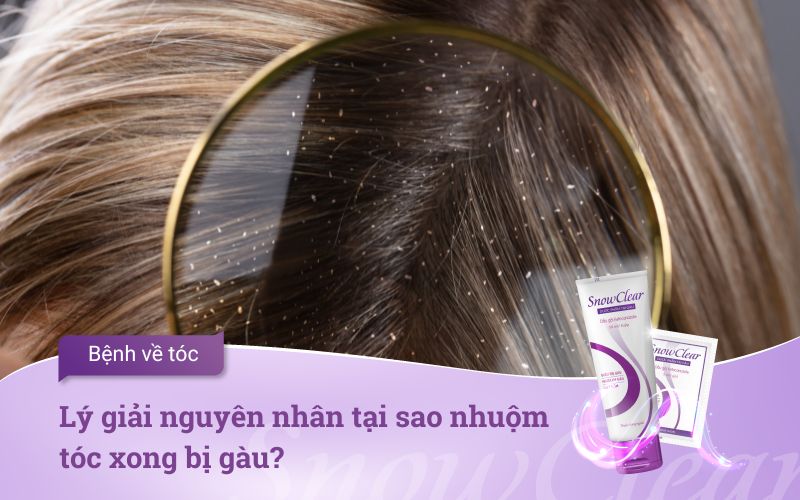 Lý giải nguyên nhân tại sao nhuộm tóc xong bị gàu?