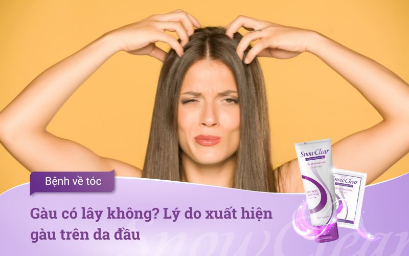 Gàu có lây không? Lý do xuất hiện gàu trên da đầu