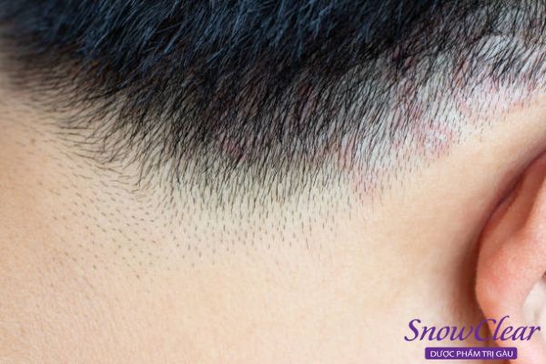 Xuất hiện các nốt mụn gây ngứa ngáy trên đầu