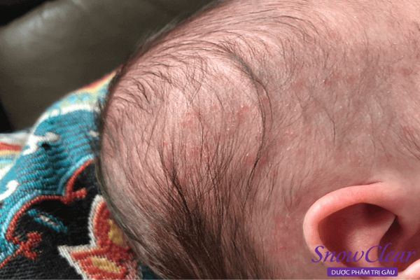 Triệu chứng nhận biết bé bị nấm da đầu 