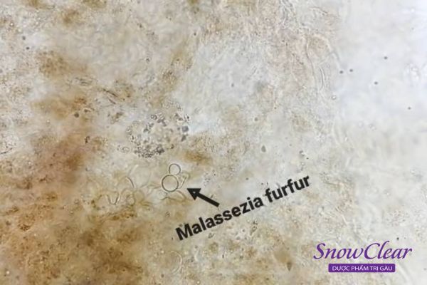 Hình ảnh nấm malassezia dưới kính hiển vi