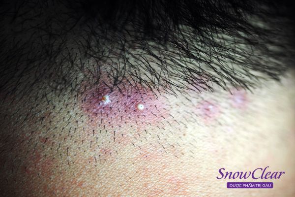 Da đầu bị nhiễm nấm malassezia sẽ nổi mụn đỏ khi vỡ sẽ lan ra các vùng da xung quanh