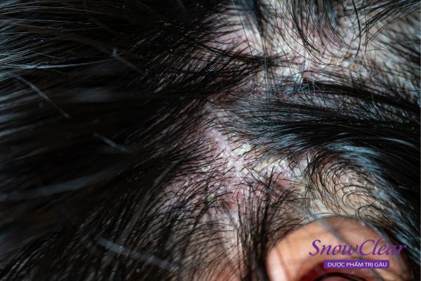 Da đầu bị bết, có nhiều chất bã do nấm Malassezia gây ra