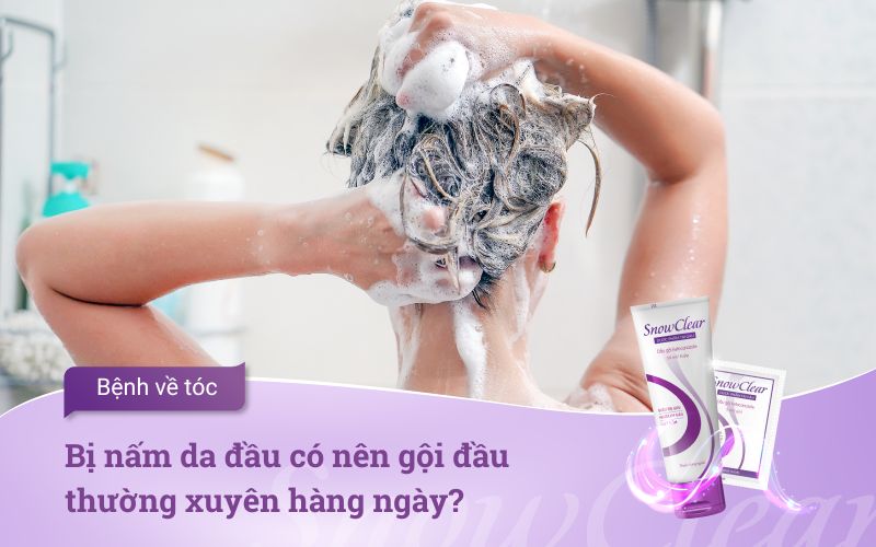Bị nấm da đầu có nên gội đầu thường xuyên hàng ngày?