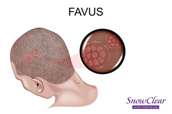 Da đầu bị nấm favus đóng vảy thành từng mảng trên da đầu và gây nhiễm trùng da đầu