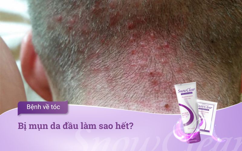 Bị mụn da đầu làm sao hết?