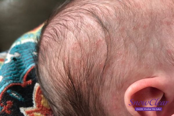 Da đầu bị nổi mẩn đỏ ở trẻ em do rôm sảy 