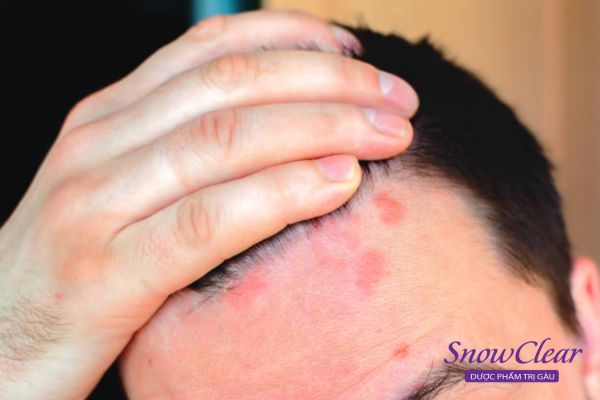 Viêm da tiết bã gây sưng đỏ và ngứa ngáy trên da đầu