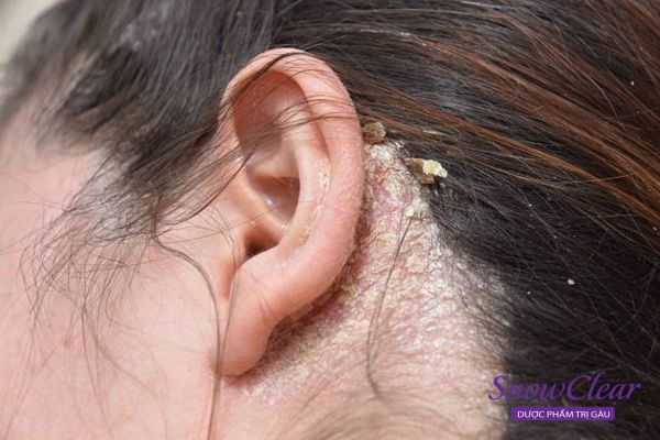 Triệu chứng của bệnh viêm da tiết bã ở đầu là da đầu xuất hiện các vảy da bong tróc