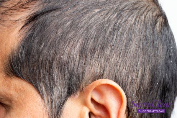 Bệnh viêm da đầu tiết bã đi kèm với tình trạng tóc bết vì da đầu tăng tiết bã nhờn