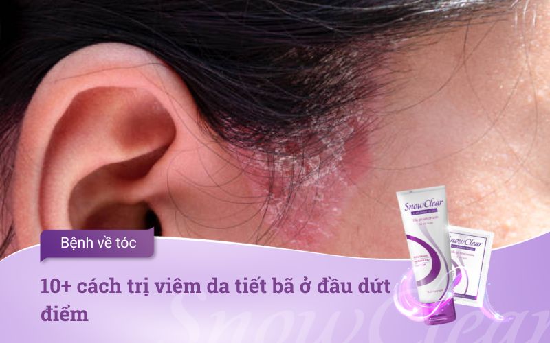 10+ cách trị viêm da tiết bã ở đầu dứt điểm