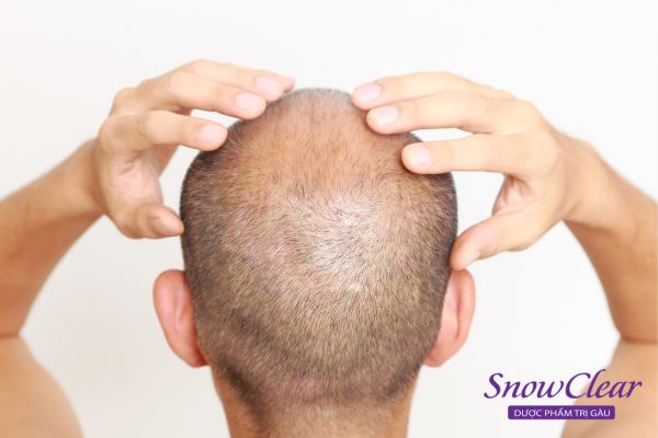 Mát-xa cho tóc và da đầu giúp tóc kích thích mọc sau điều trị hóa trị