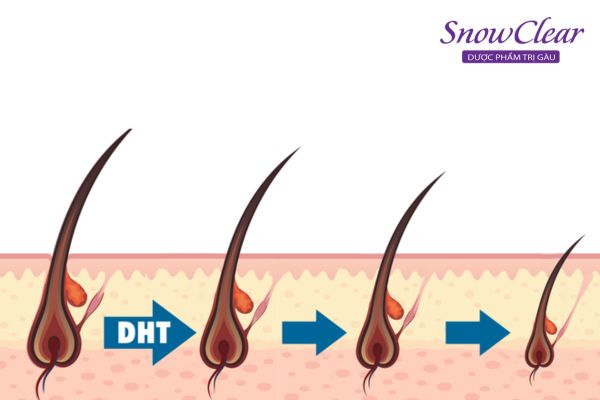 DHT tăng cao làm nang tóc yếu gây ra tình trạng rụng tóc ở nữ 17 tuổi 