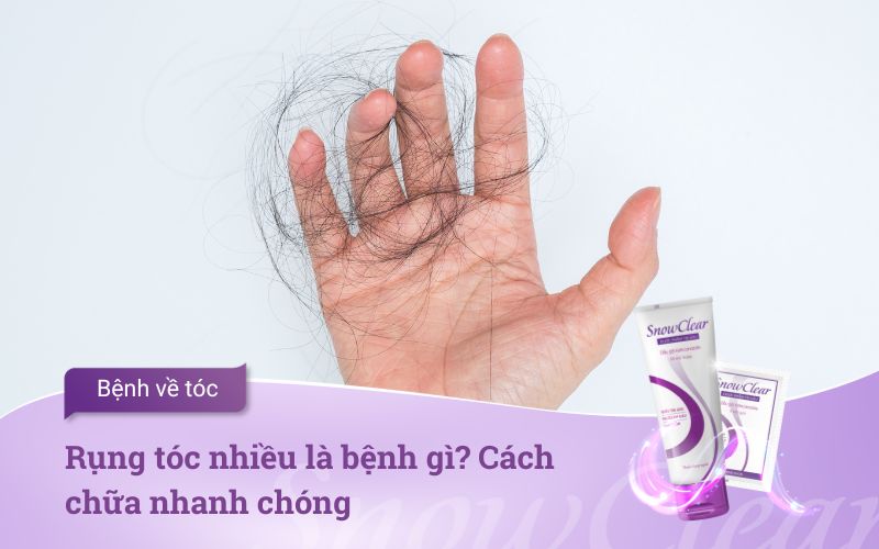 Rụng tóc nhiều là bệnh gì? Cách chữa nhanh chóng