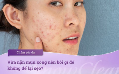 Vừa nặn mụn xong nên bôi gì để không để lại sẹo?