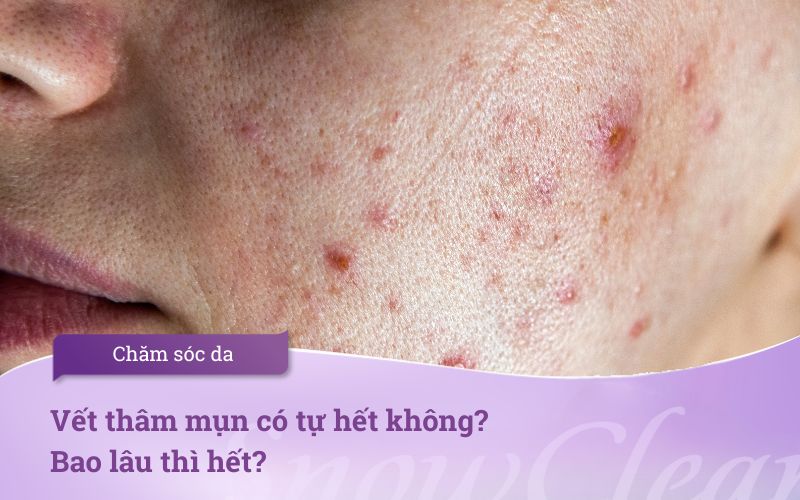 Vết thâm mụn có tự hết không? Bao lâu thì hết?