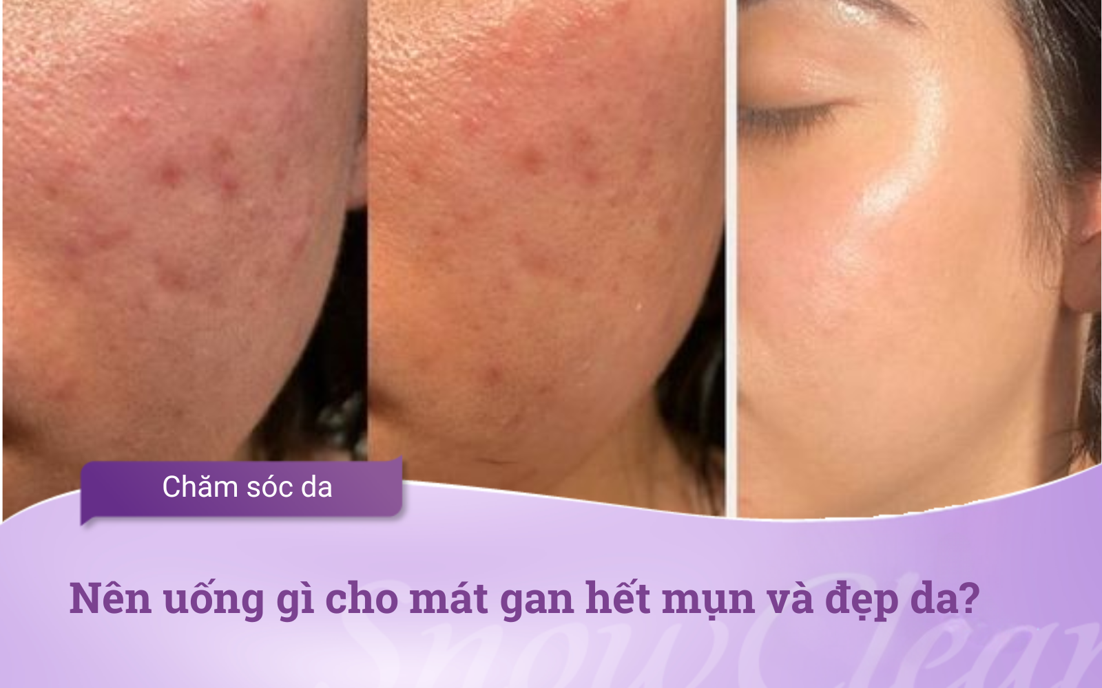 Nên uống gì cho mát gan hết mụn và đẹp da?