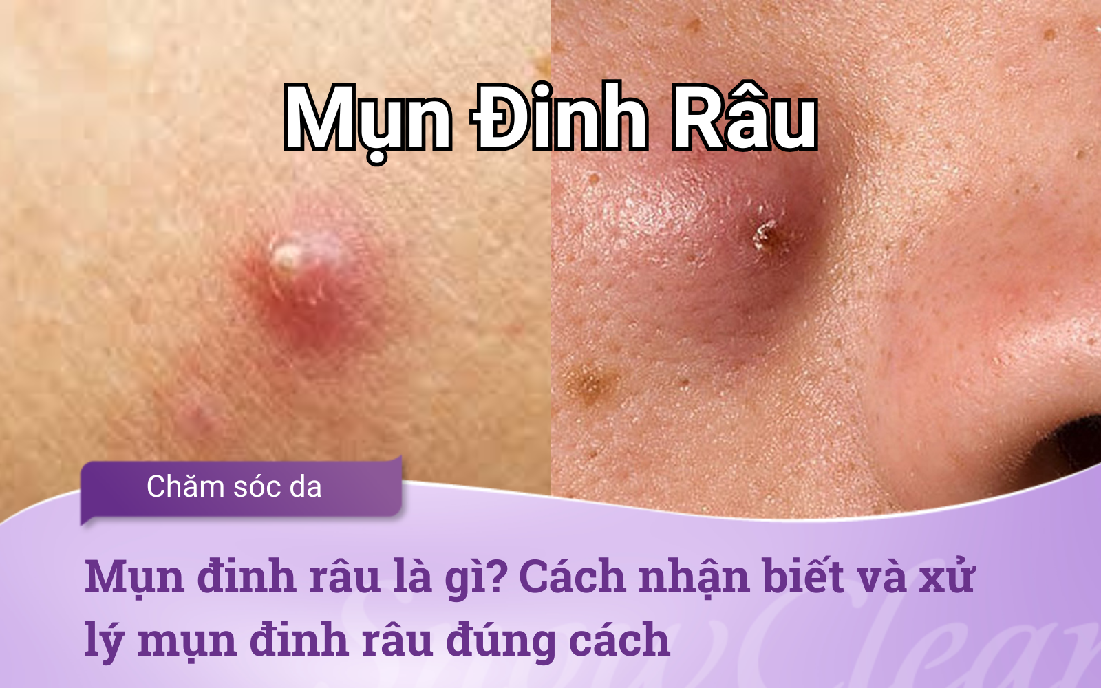 Mụn đinh râu hiểu rõ dấu hiệu và phương pháp điều trị an toàn hiệu quả