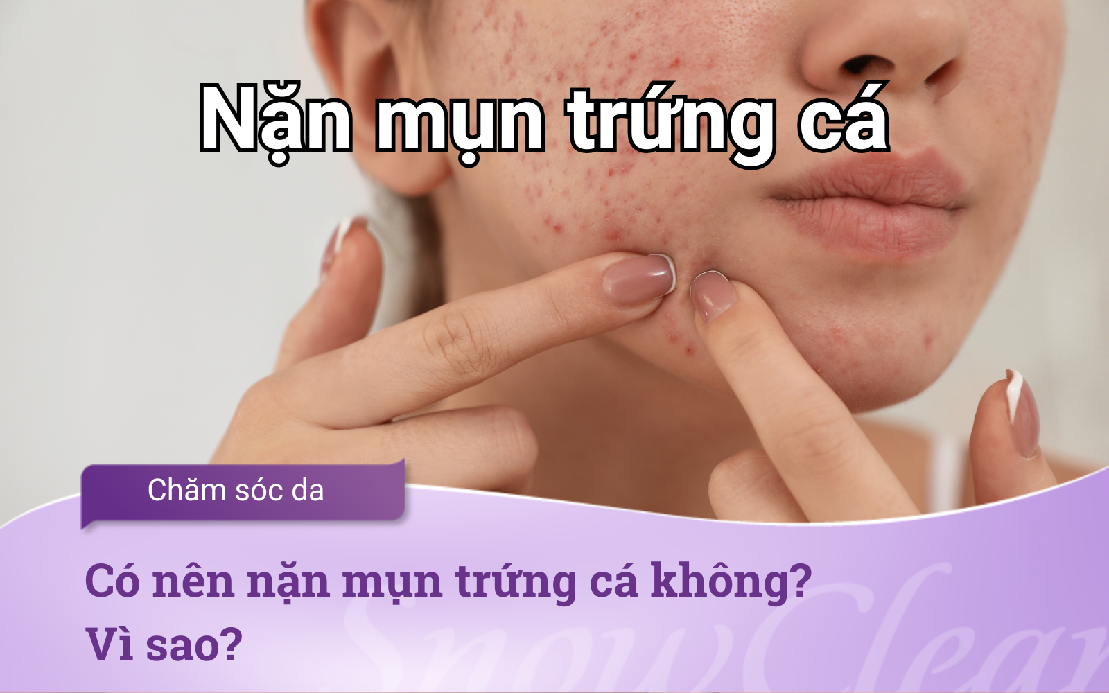 Có nên nặn mụn trứng cá không? Vì sao?