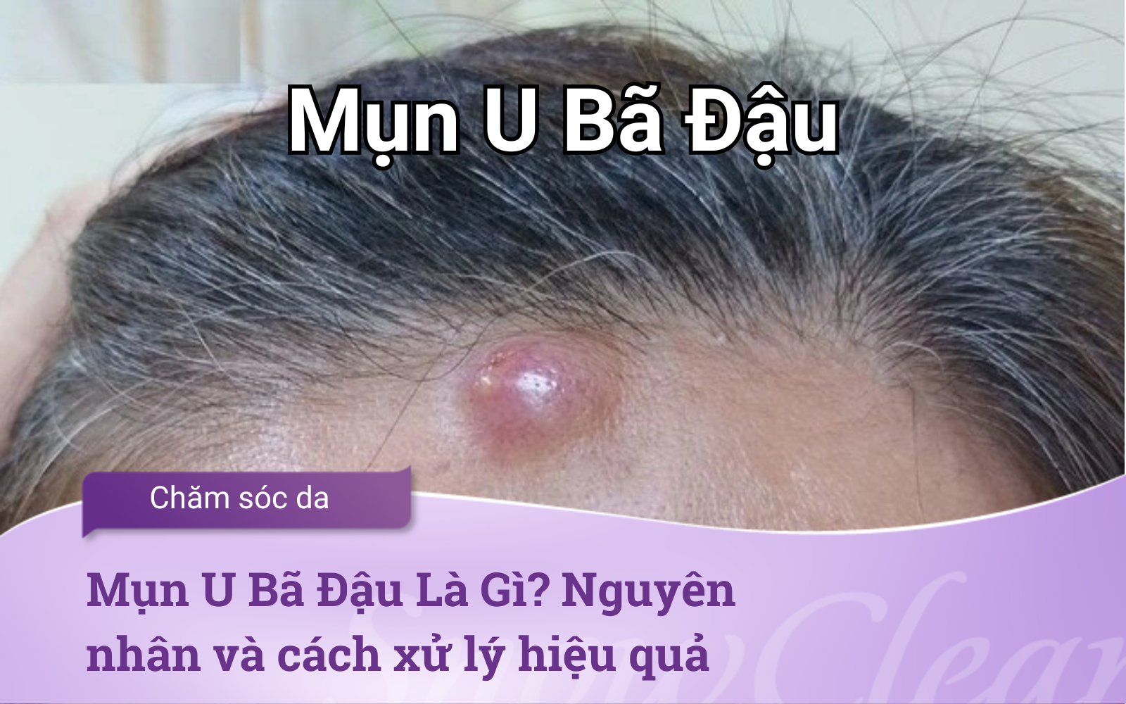 Mụn U Bã Đậu Là Gì? Những điều cần biết để ngăn ngừa U bã đậu