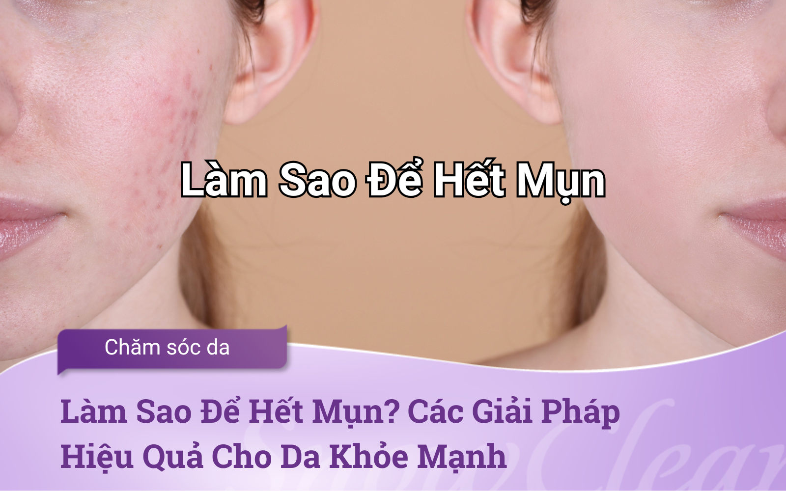 Làm Sao Để Hết Mụn? Các Giải Pháp Hiệu Quả Cho Da Khỏe Mạnh