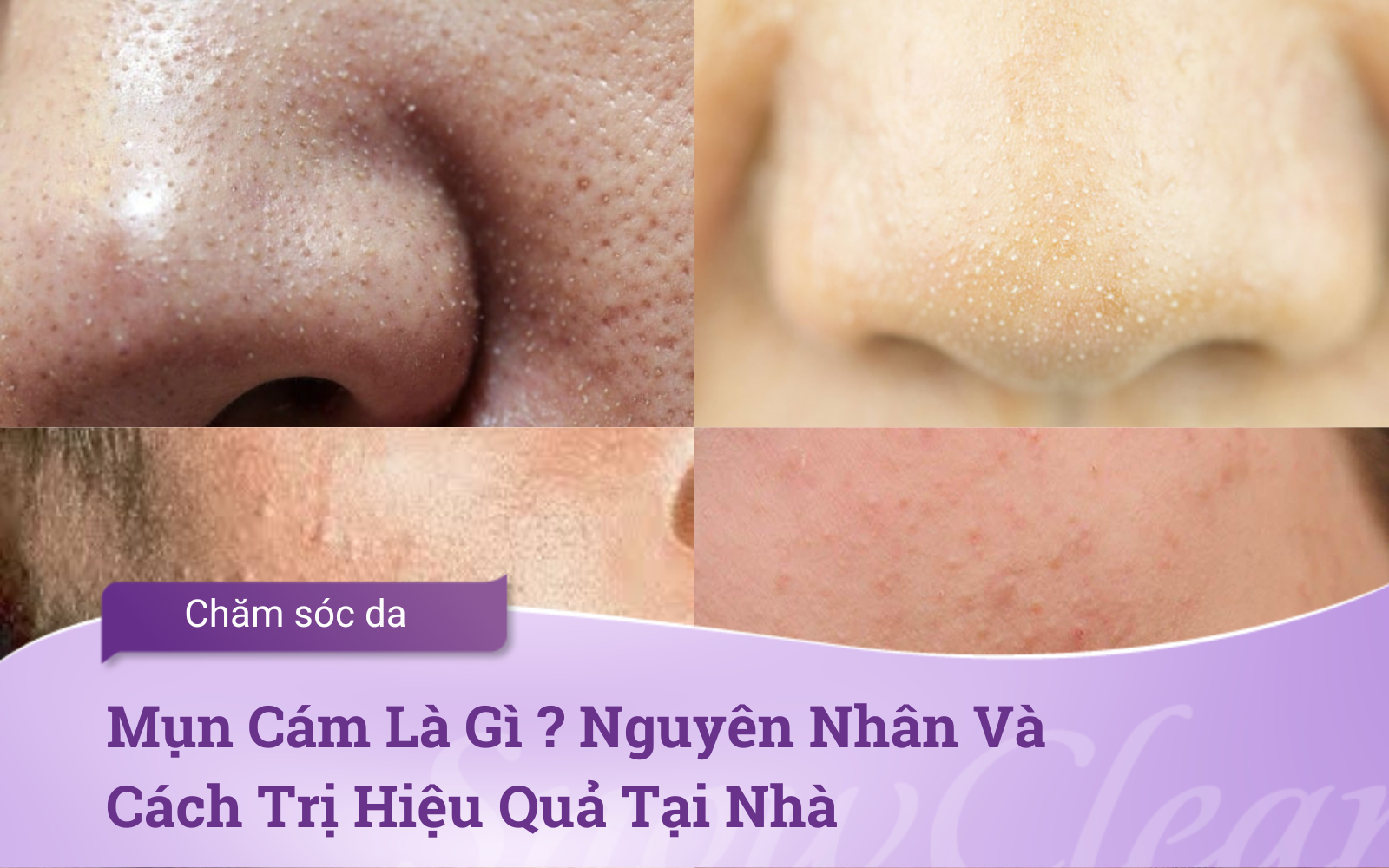 Mụn Cám Là Gì ? Những điều cần biết về mụn cám