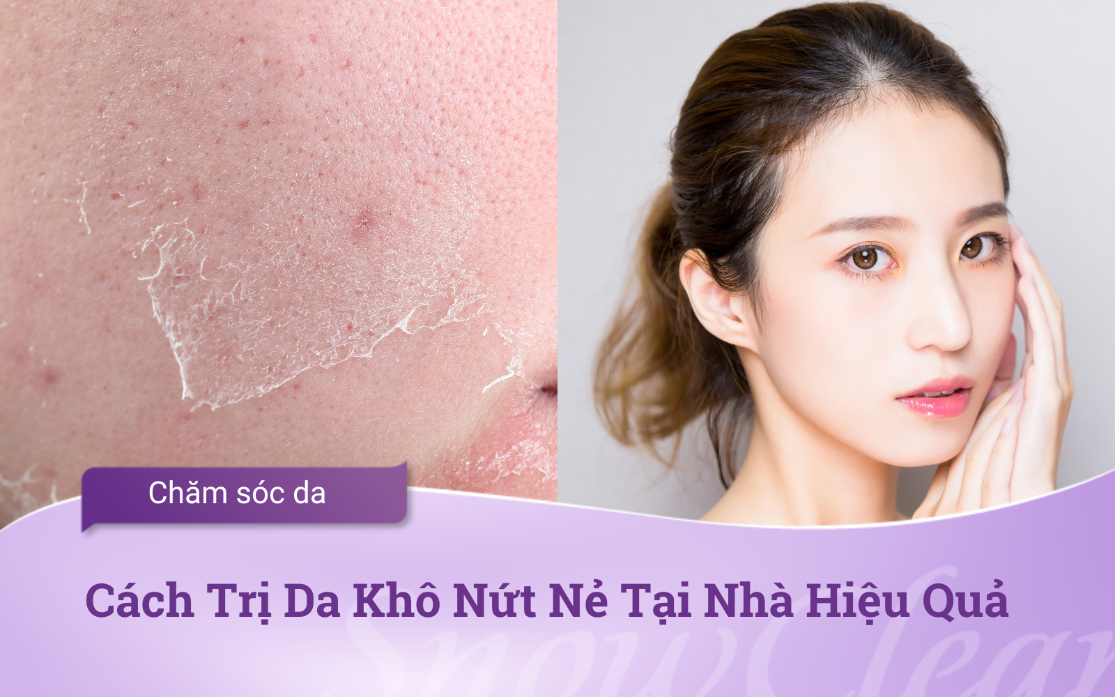 Cách Trị Da Khô Nứt Nẻ Tại Nhà Hiệu Quả