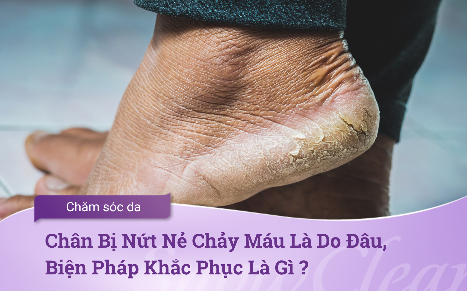 Chân Bị Nứt Nẻ Chảy Máu Là Do Đâu, Biện Pháp Khắc Phục Là Gì ?