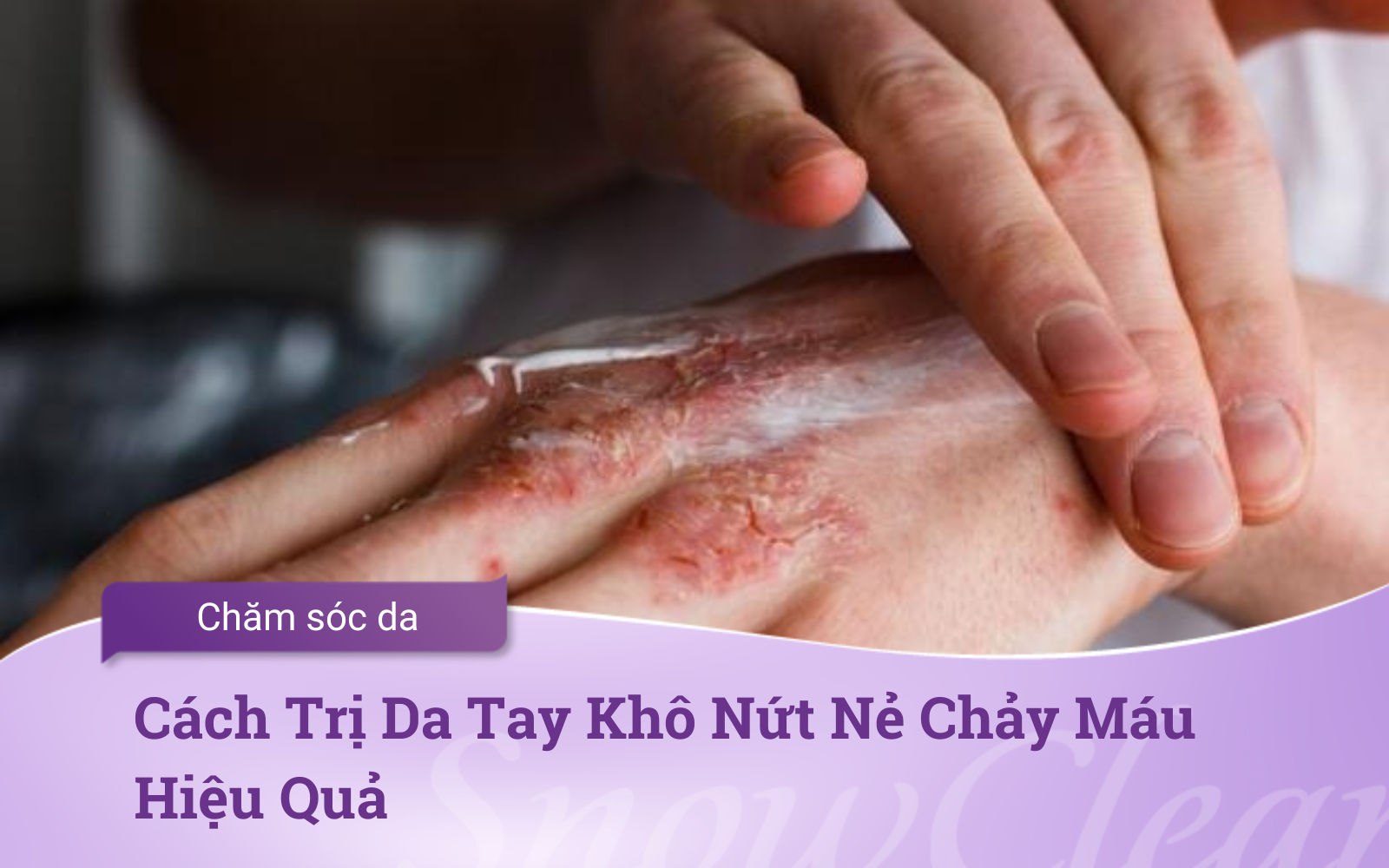 Cách Trị Da Tay Khô Nứt Nẻ Chảy Máu Hiệu Quả