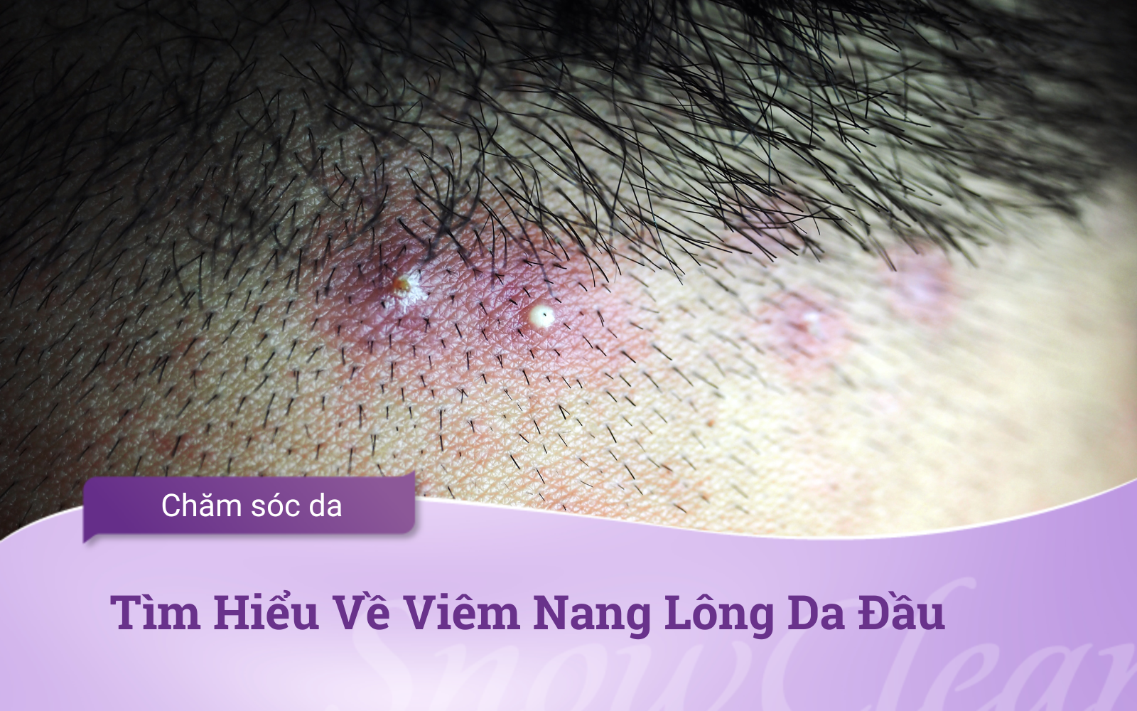 Tìm hiểu về Viêm Nang Lông Da Đầu