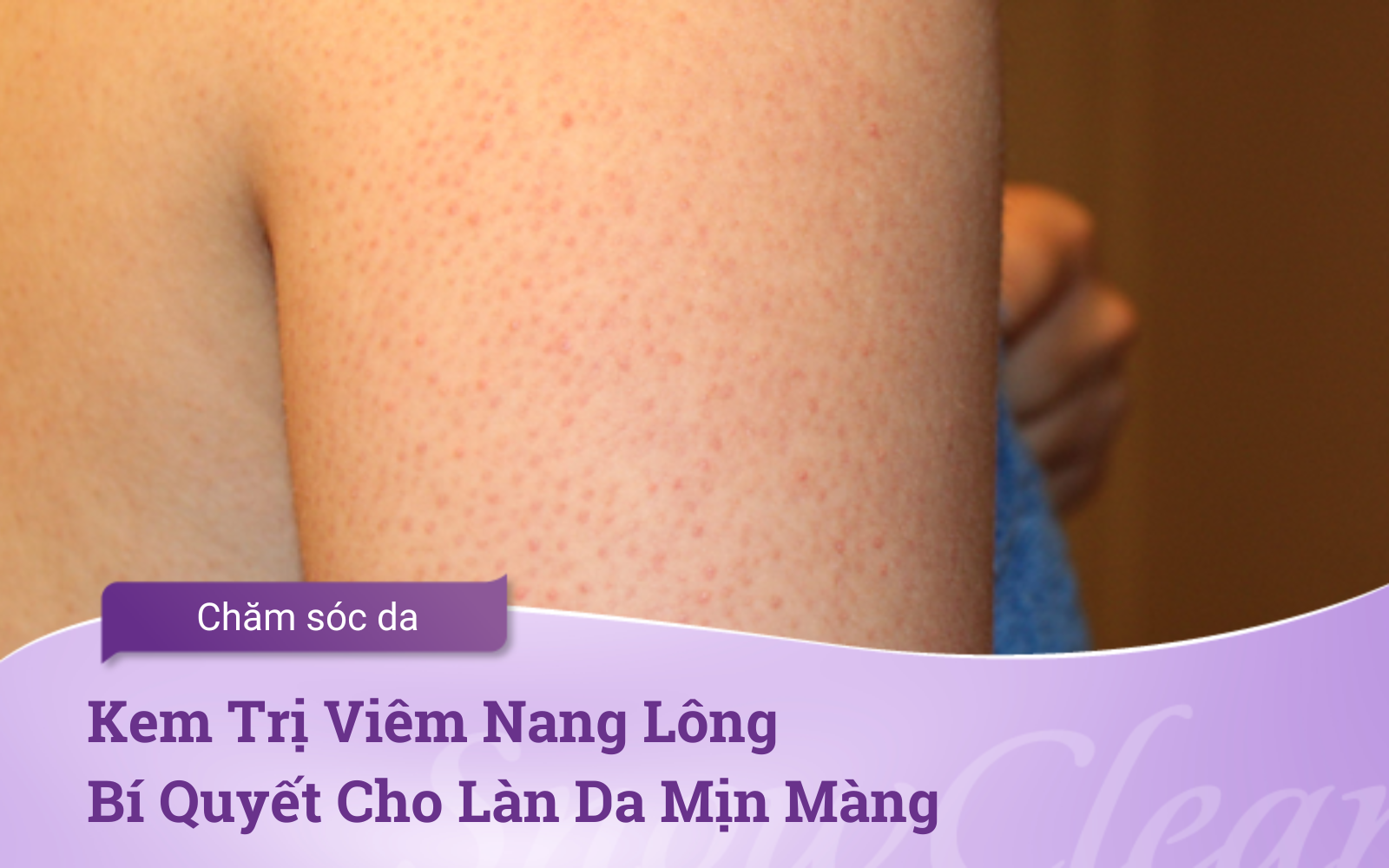 Kem Trị Viêm Nang Lông Bí Quyết Cho Làn Da Mịn Màng