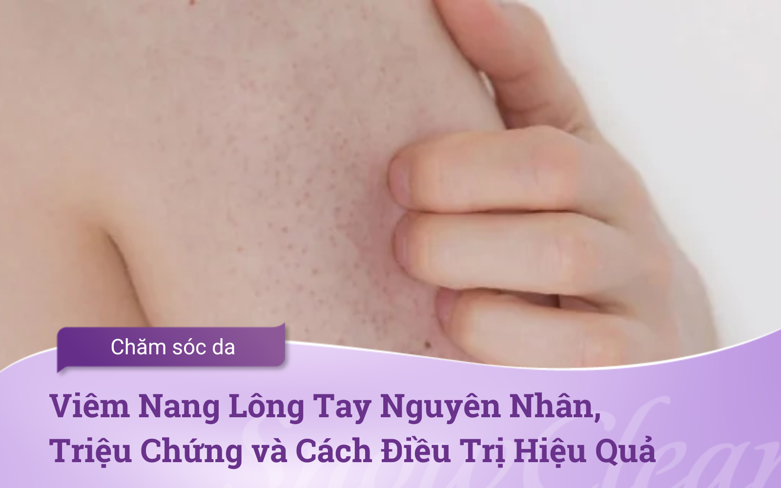 Viêm Nang Lông Tay Nguyên Nhân, Triệu Chứng và Cách Điều Trị Hiệu Quả