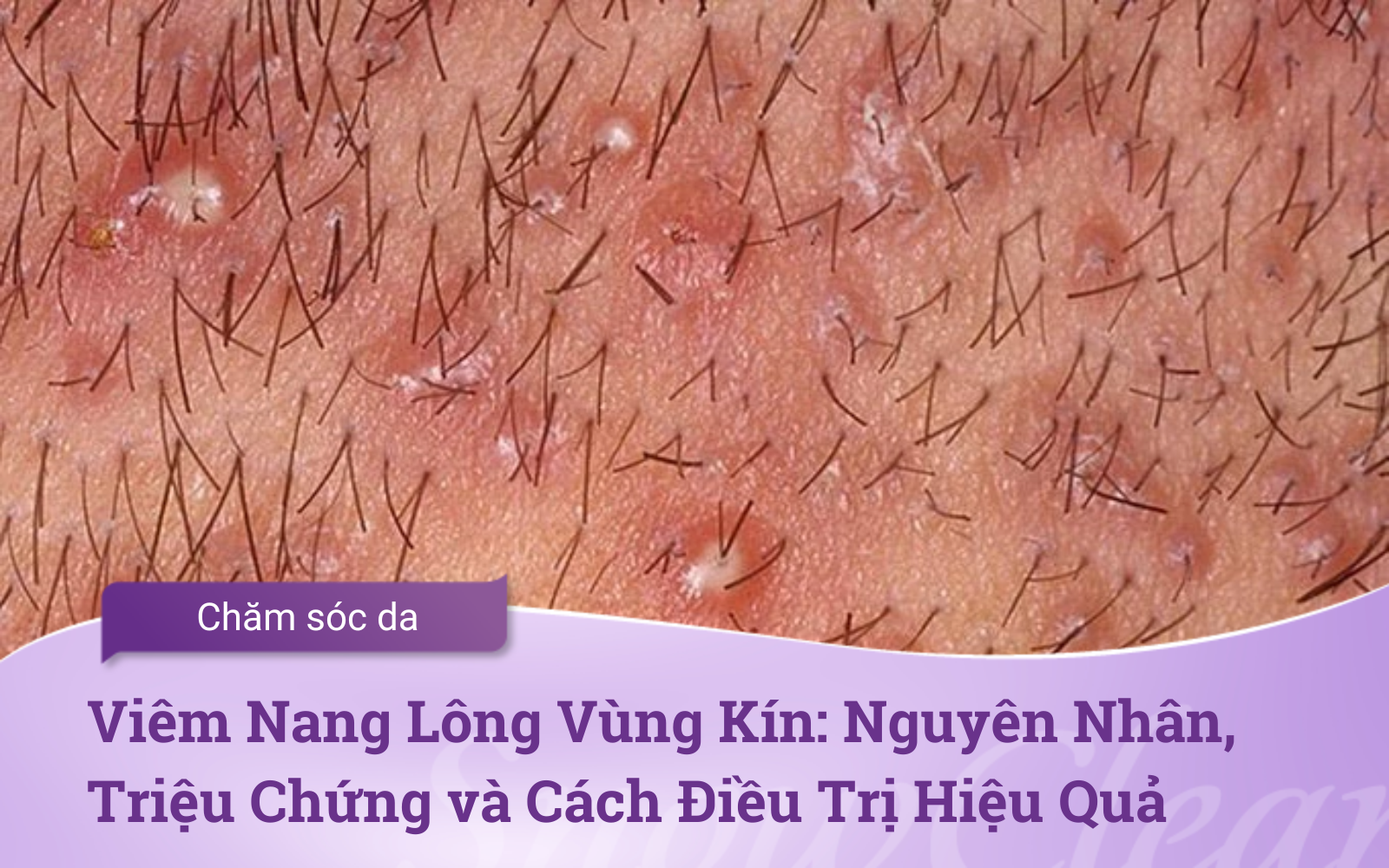 Viêm Nang Lông Vùng Kín: Nguyên Nhân, Triệu Chứng và Cách Điều Trị Hiệu Quả