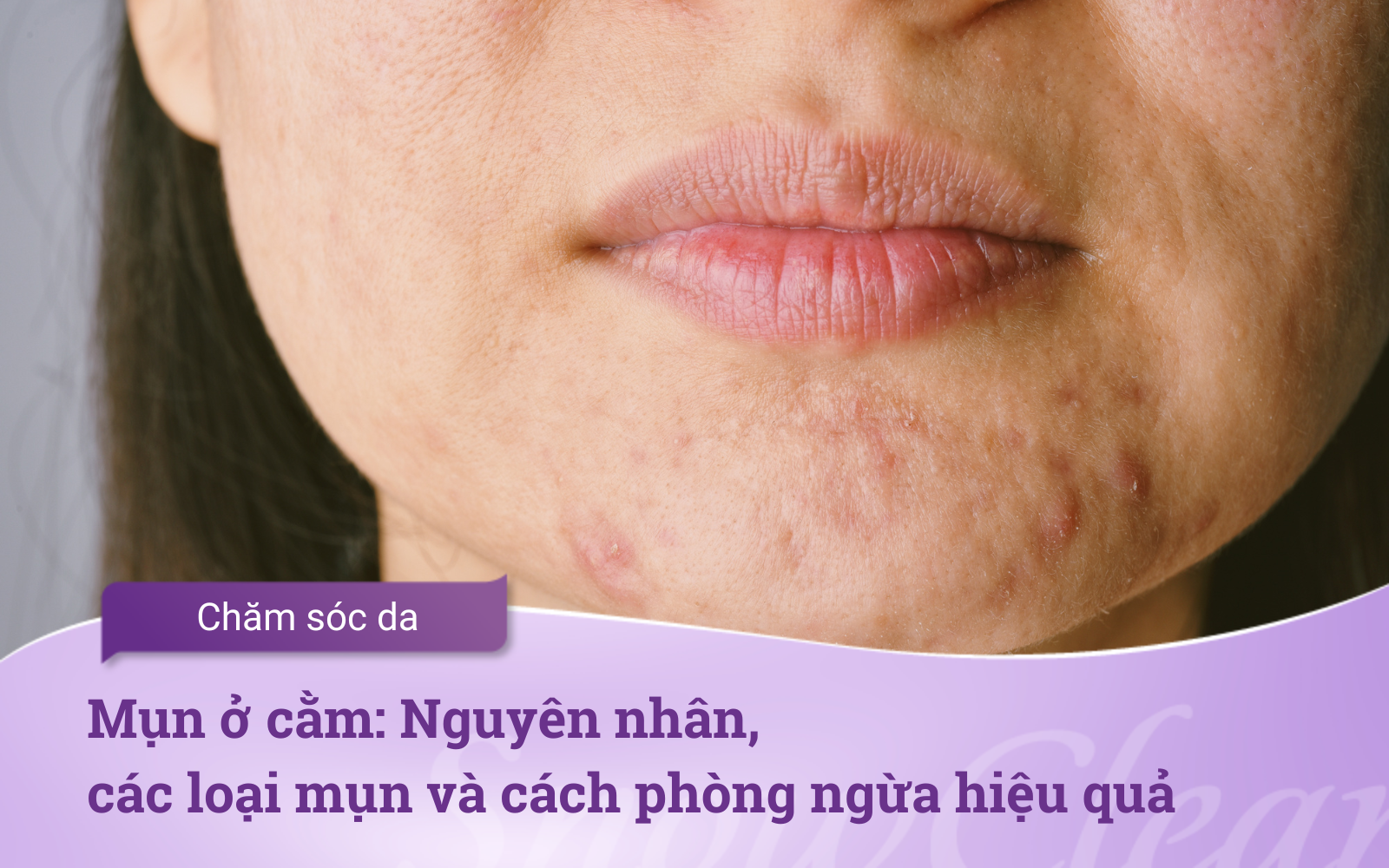 Mụn ở cằm: Nguyên nhân, các loại mụn và cách phòng ngừa hiệu quả