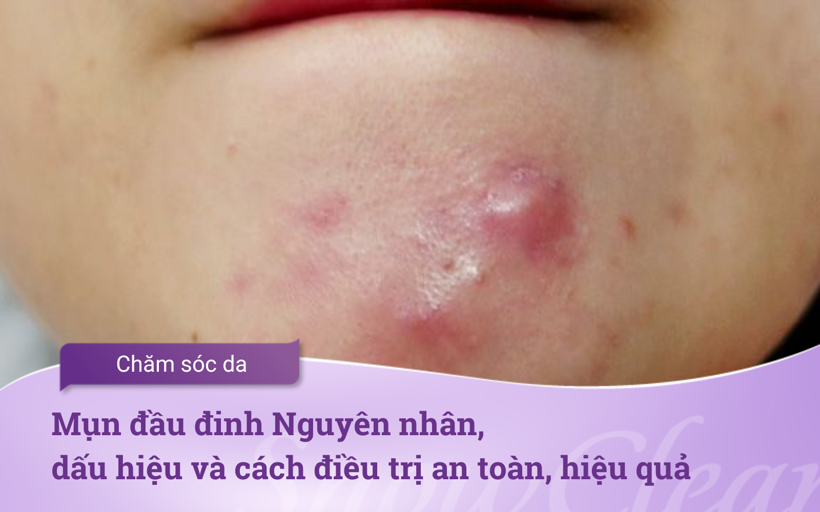 Mụn đầu đinh Nguyên nhân, dấu hiệu và cách điều trị an toàn, hiệu quả