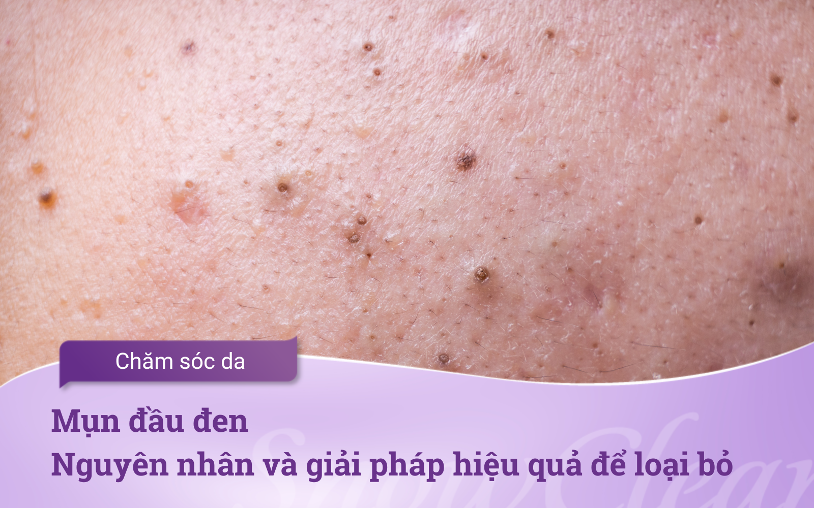 Mụn đầu đen: Nguyên nhân và giải pháp hiệu quả để loại bỏ