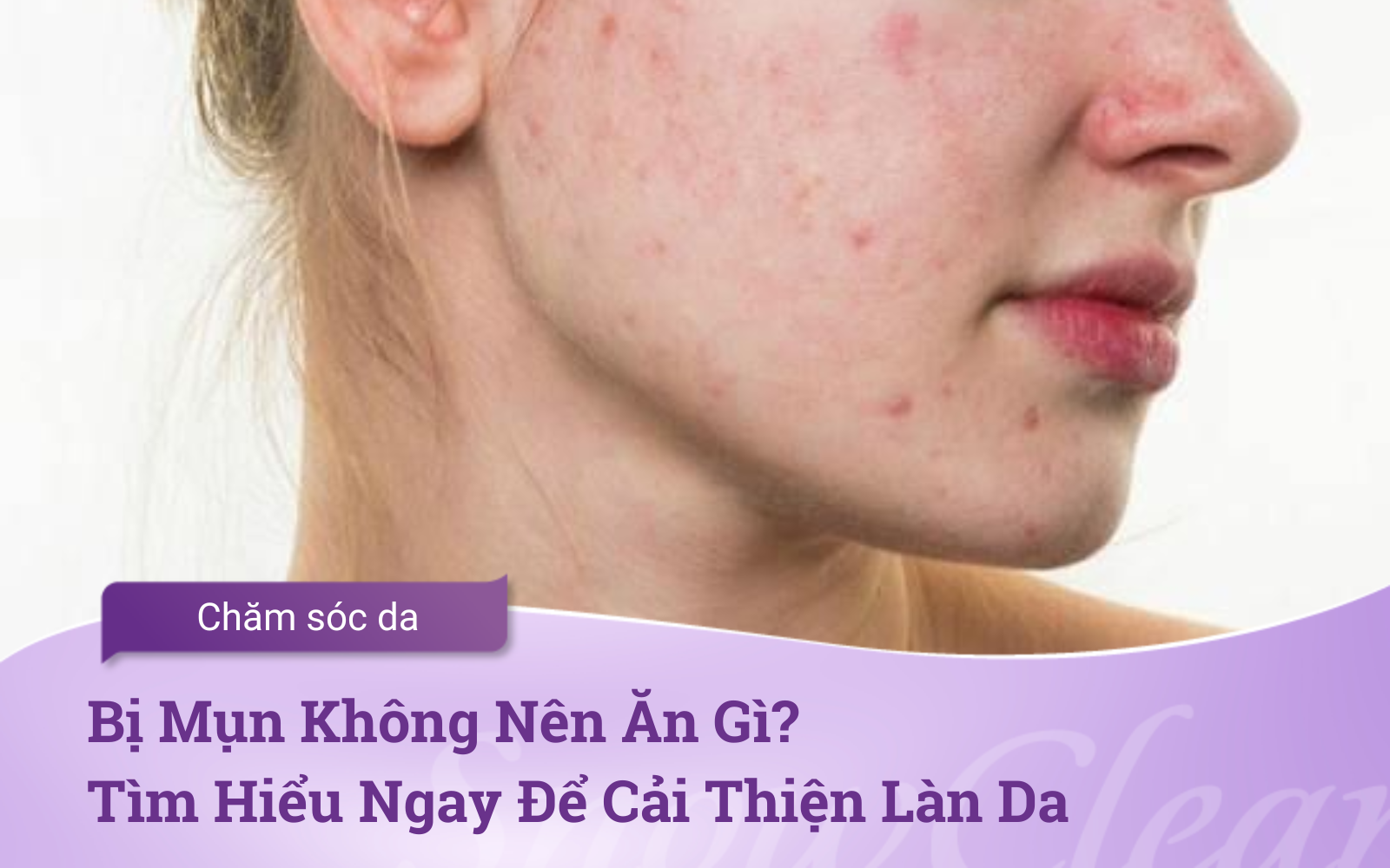 Bị Mụn Không Nên Ăn Gì? Tìm Hiểu Ngay Để Cải Thiện Làn Da