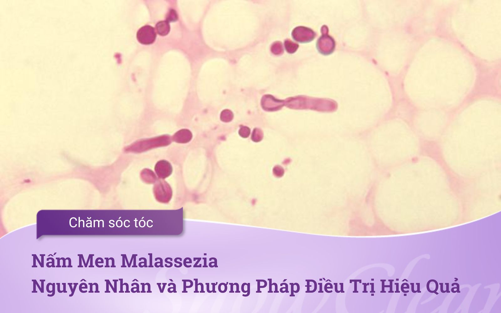 Nấm Men Malassezia Nguyên Nhân và Phương Pháp Điều Trị Hiệu Quả