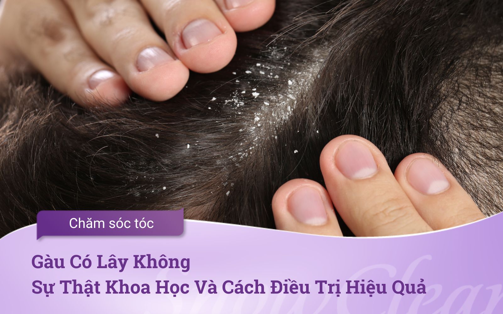 Gàu Có Lây Không Sự Thật Khoa Học Và Cách Điều Trị Hiệu Quả