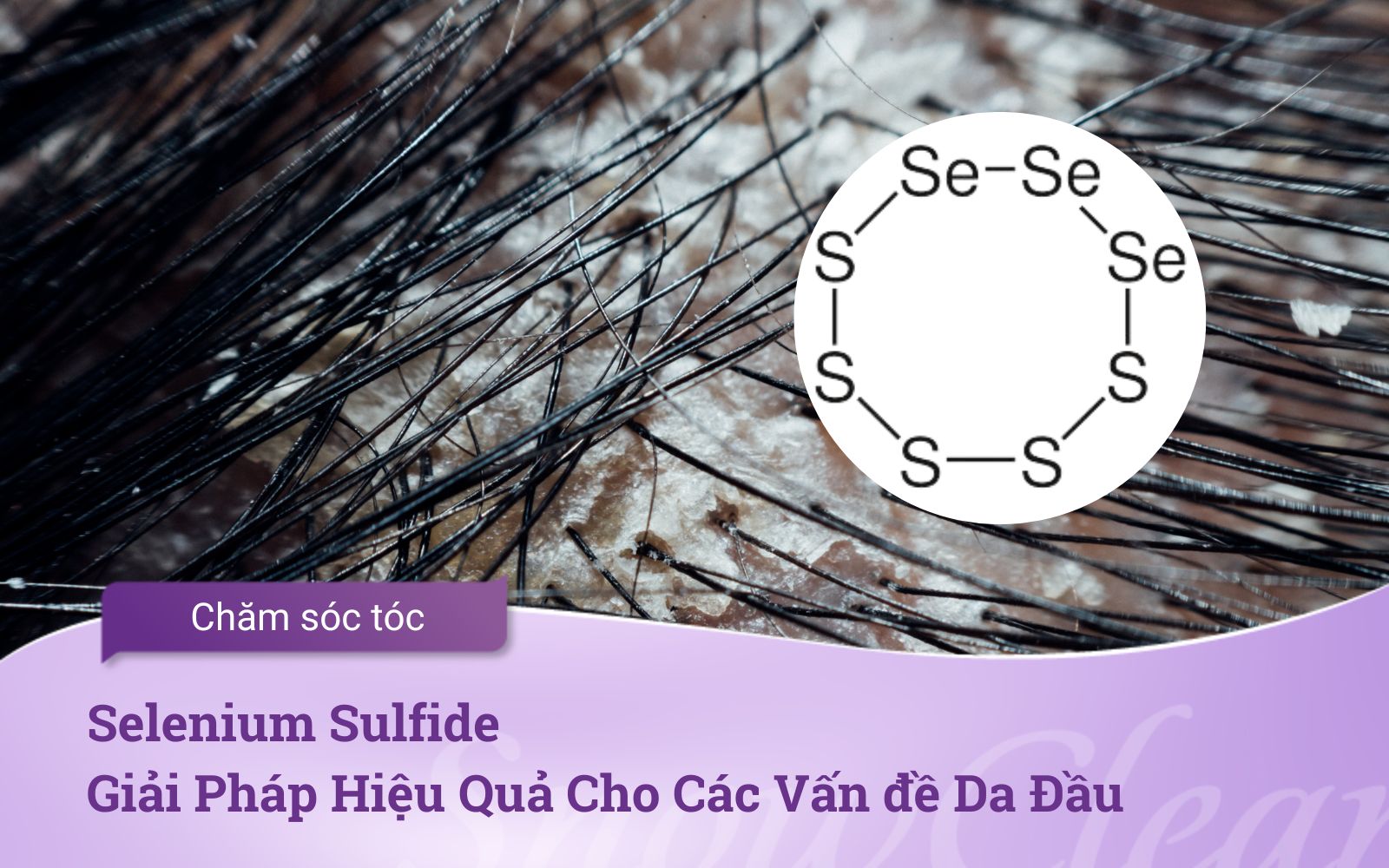 Selenium Sulfide Giải Pháp Hiệu Quả Cho Các Vấn đề Da Đầu