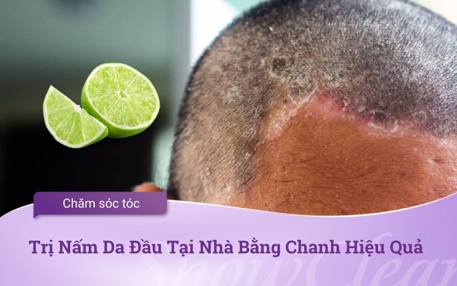 Trị Nấm Da Đầu Tại Nhà Bằng Chanh Hiệu Quả