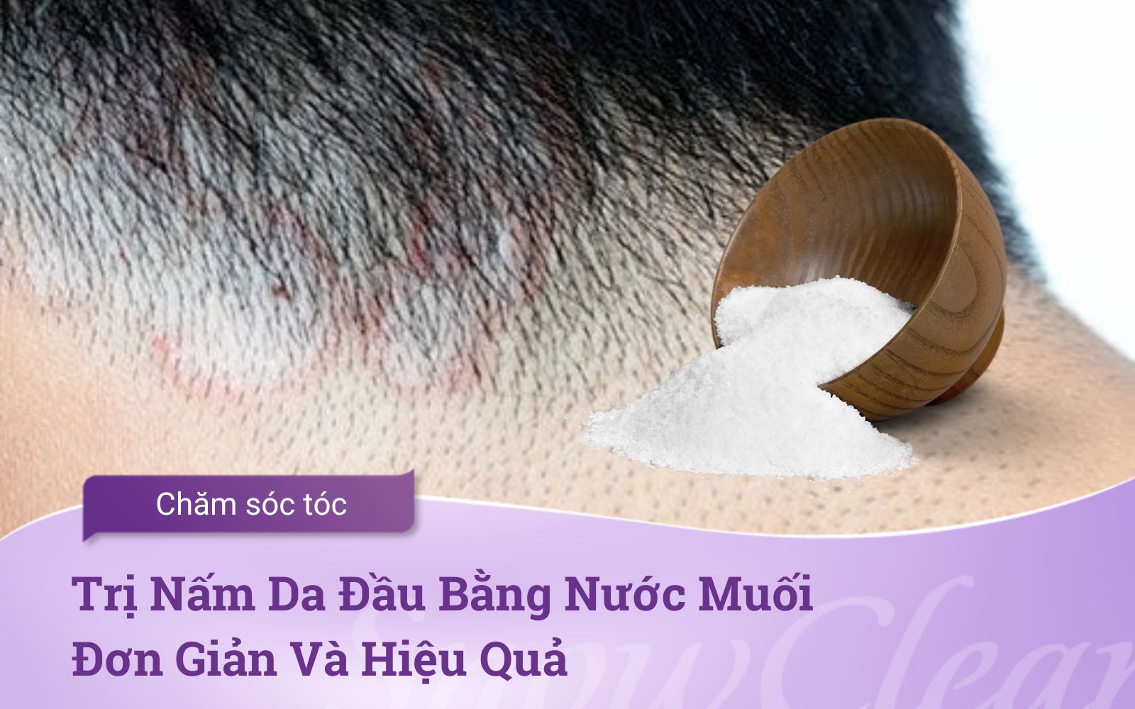Trị Nấm Da Đầu Bằng Nước Muối Đơn Giản Và Hiệu Quả