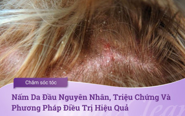 Nấm Da Đầu Nguyên Nhân, Triệu Chứng Và Phương Pháp Điều Trị Hiệu Quả